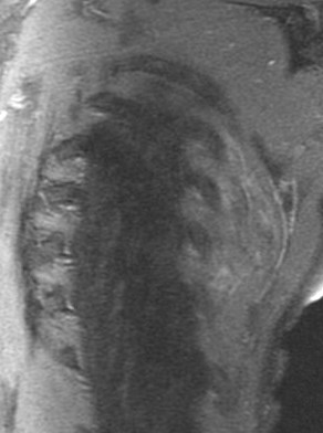 Figure 4 for case Elastofibroma dorsi